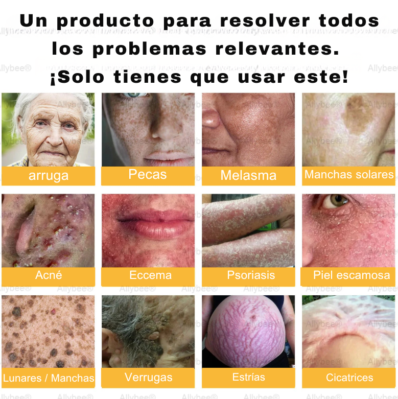 Crema Hoijkea™ | El descubrimiento natural "prohibido" que borra años de daño cutáneo y pone fin a la batalla diaria contra la psoriasis, las arrugas y las afecciones cutáneas crónicas