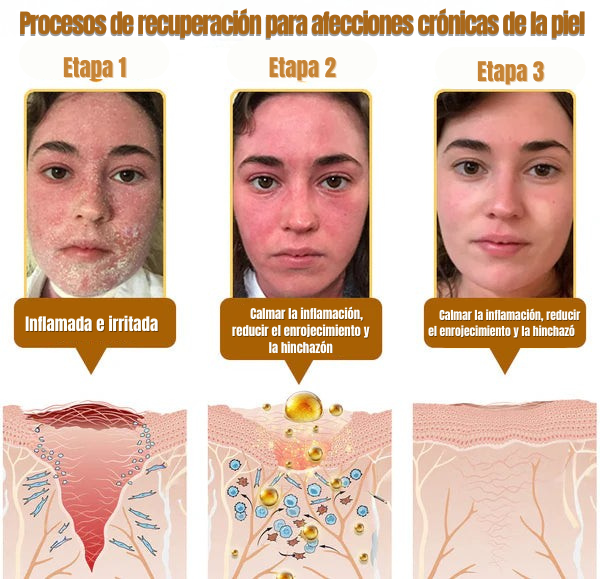 Crema Hoijkea™ | El descubrimiento natural "prohibido" que borra años de daño cutáneo y pone fin a la batalla diaria contra la psoriasis, las arrugas y las afecciones cutáneas crónicas