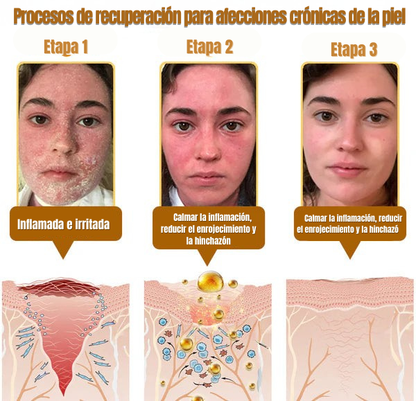 Crema Hoijkea™ | El descubrimiento natural "prohibido" que borra años de daño cutáneo y pone fin a la batalla diaria contra la psoriasis, las arrugas y las afecciones cutáneas crónicas